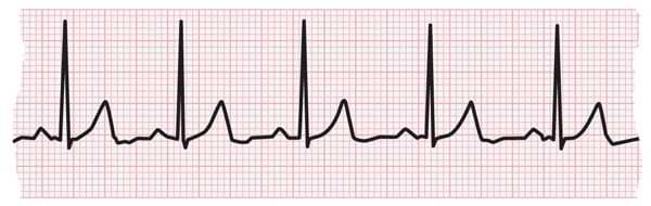 Tira de ECG que muestra un latido de corazón normal